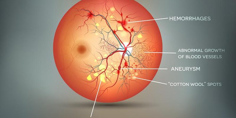 Diabetic Retinopathy: Prevention Control