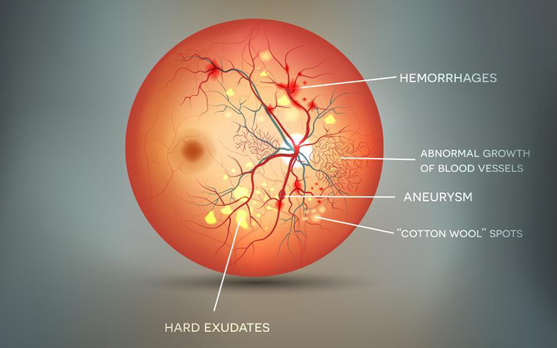 Diabetic Retinopathy: Prevention Control